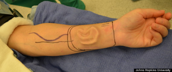 Woman Needs a New Ear, Grows a New One on Her&nbsp;Arm