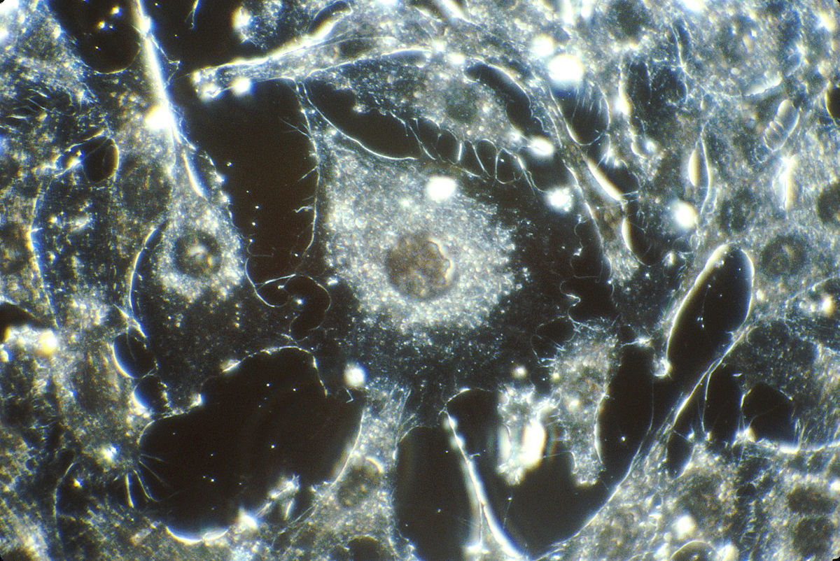 https://commons.wikimedia.org/wiki/File:Cancer_cells.jpg